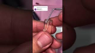 De Esta Manera Obturamos Una Endodoncia