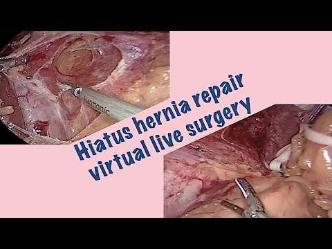 Video: Hernia Of The Esophageal Opening Of The Diaphragm - Symptoms, Treatment, Surgery