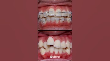 Quá trình chạy răng khi niềng răng #shots #niengrang #bacsihonghoa