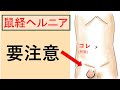 【外科医が解説】知らないとヤバイ怖い症状（脱腸で緊急手術）