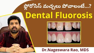 | Dental Fluorosis Explained | DermaDent Clinic |