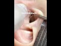 【acne pimple】やみつき角栓Part35 #acne #squeeze