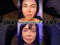 Small access, refined contour. #facelift #facecontour