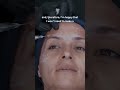 Advanced Aesthetics: Evidence-Based Forehead Filler Injection Techniques from the GEM© Clinic 💎