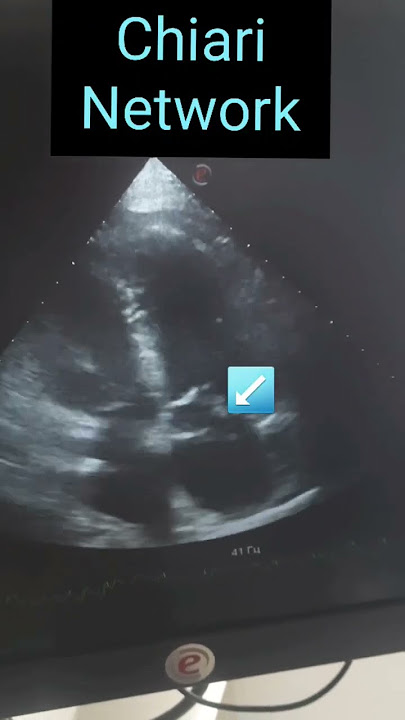 #ChiariNetwork #ECHO #CardiologyCase #UltrasoundFindings #HeartAnatomy #MedicalEducation