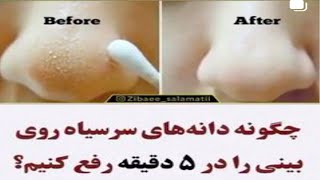 چگونه دانه های سرسیاه روی بینی را در ۵ دقیقه رفع کنیم؟How to get rid of blackheads on the nose!