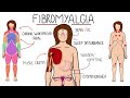 Fibromyalgia - A Chronic Pain Disorder (Includes Symptoms, Criteria & Treatment Options)