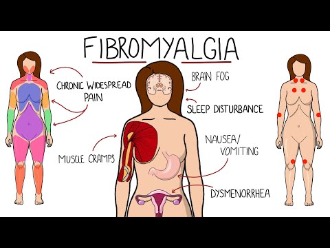 Fibromyalgia - A Chronic Pain Disorder (Includes Symptoms, Criteria & Treatment Options)
