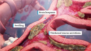 What Is Severe Asthma?