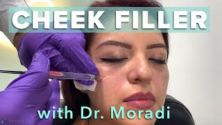 Watch This Patient Get Cheek Filler! Before \& After Restylane Contour