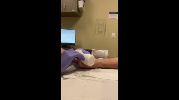 Xiaflex Manipulations for Dupuytren