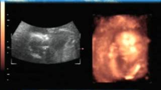 Gravimagem 4961 Ultrom 3D 4D Gravidez Com 21 Semanas