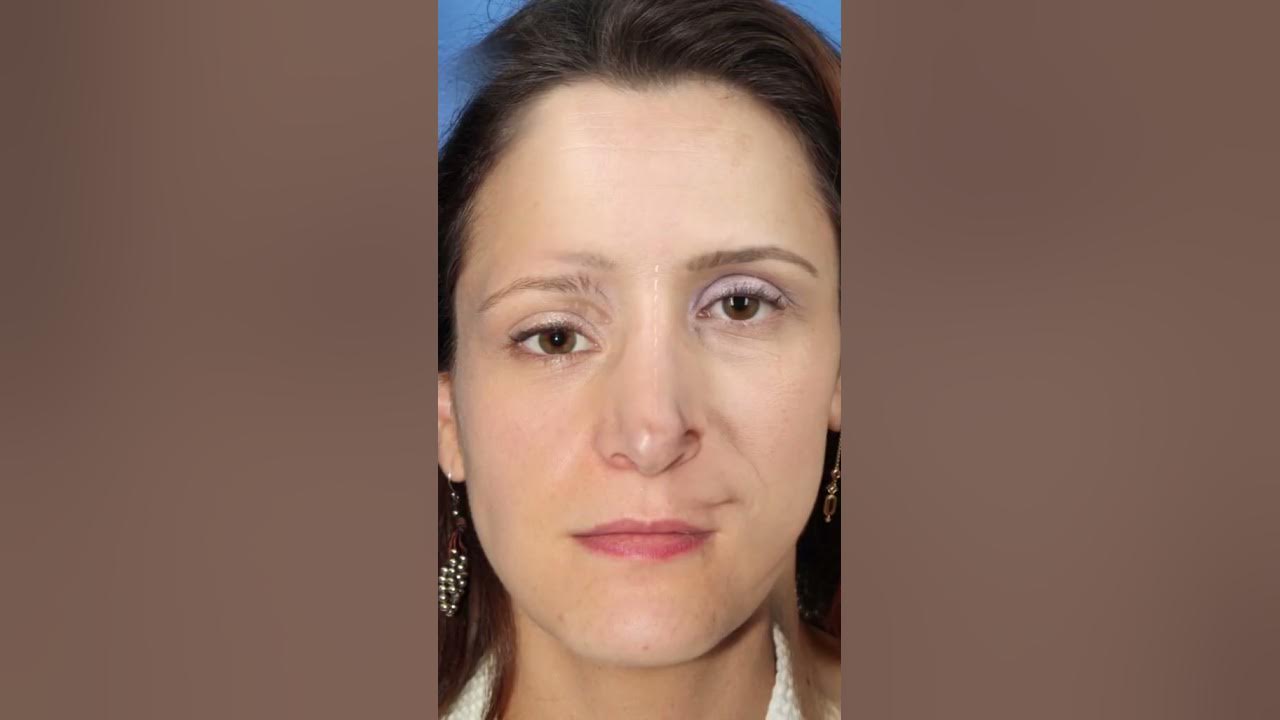 septoplasty-before-and-after-correcting-very-deviated-septum-youtube