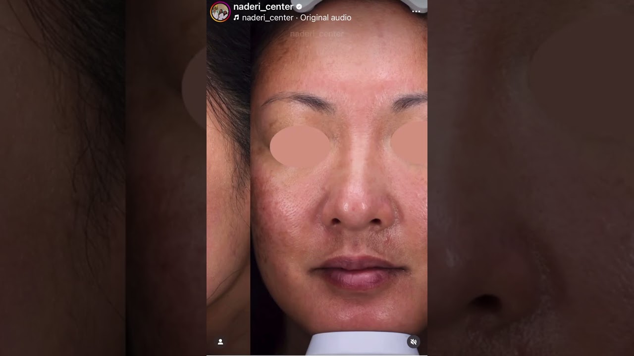 Non surgical skin tightening without the downtime ✨ 