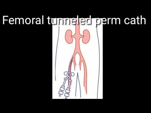 Femoral Perm catheter placement | Tunneled dialysis catheter via. femoral route in hyderabad