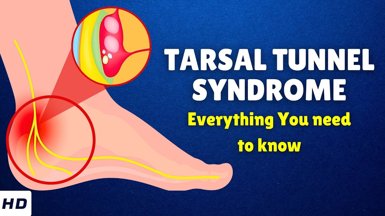 tarsal-tunnel-syndrome-causes-signs-and-symptoms-diagnosis