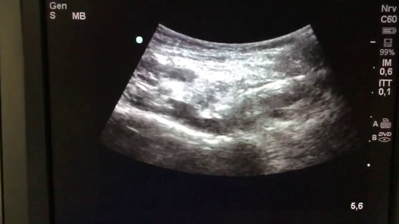 dolore all inguine ultrasound test dolore all inguine ultrasound test