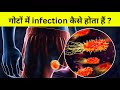 मर्द हो तो ज़रूर देखना - मर्दों के गोटों में infection