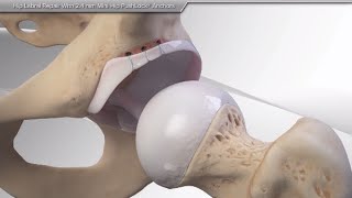 Hip Labral Tear Recovery Without Surgery