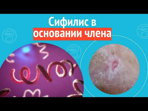 ? Сифилис в основании члена. Клинический случай №1091