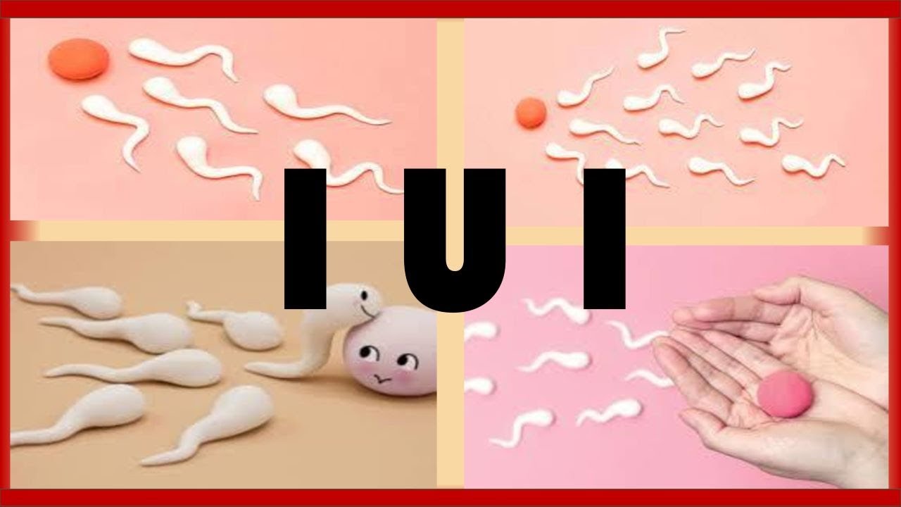 Intrauterine Insemination (IUI) What is an IUI? How to get Pregnant