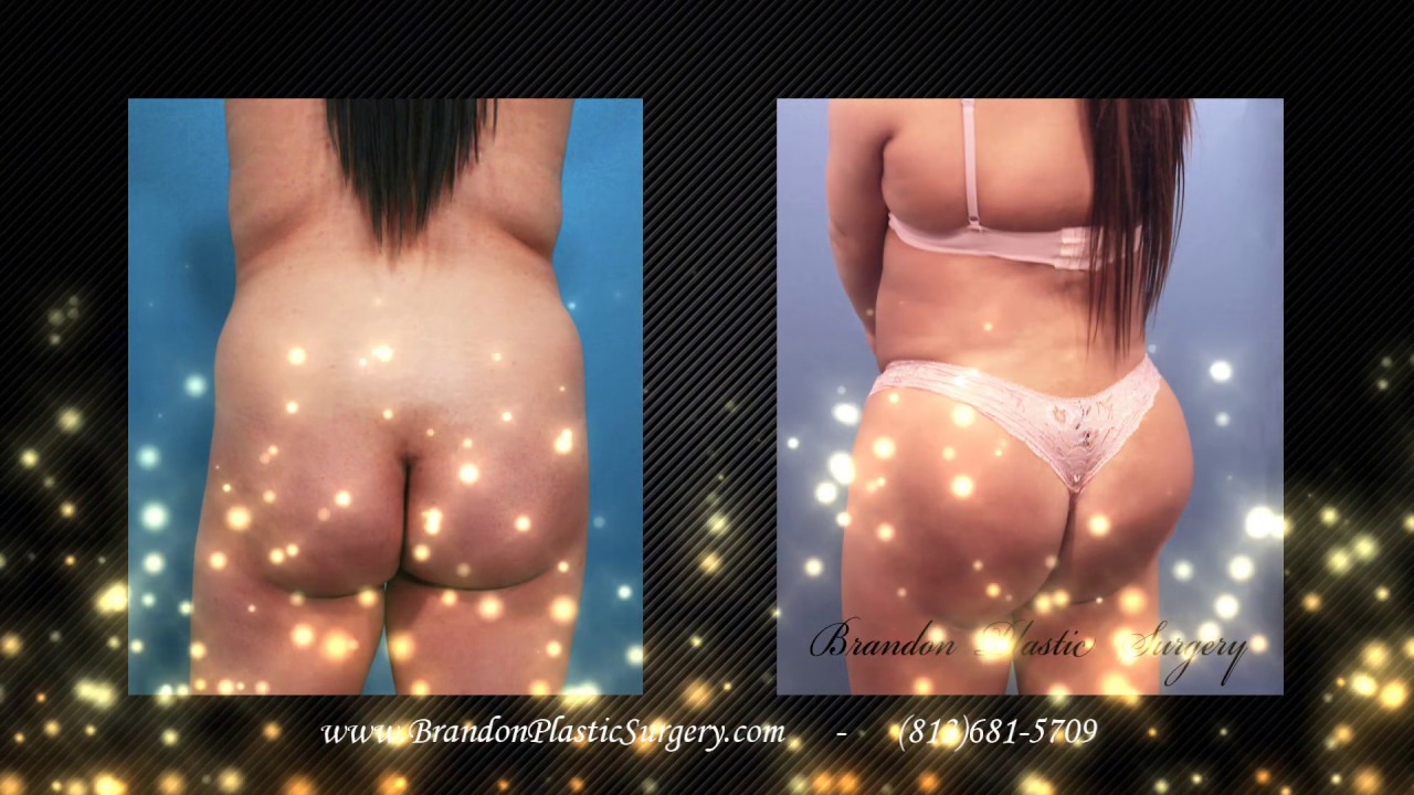 Elite Body Sculpture BBL