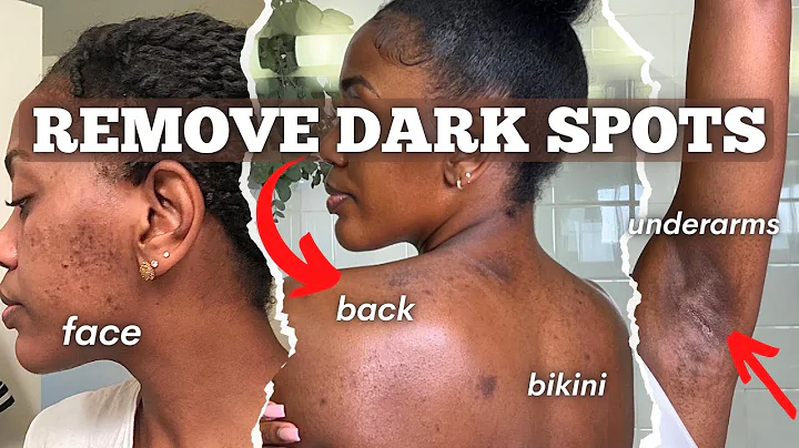 HOW TO CLEAR FULL BODY HYPERPIGMENTATION AND ACNE | Face, Underarms, Bikini, Back | SKIN ROUTINE