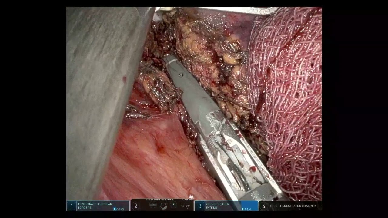 Robotic caudate lobe resection