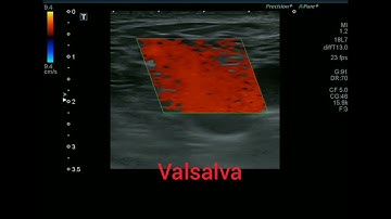 Ultrasound video showing a competent normal saphenofemoral junction, SFJ valve