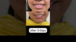 Lip Reduction surgery | Step by step | 15 Days Result