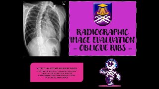 Radiographic Image Evaluation of Oblique Ribs X Ray