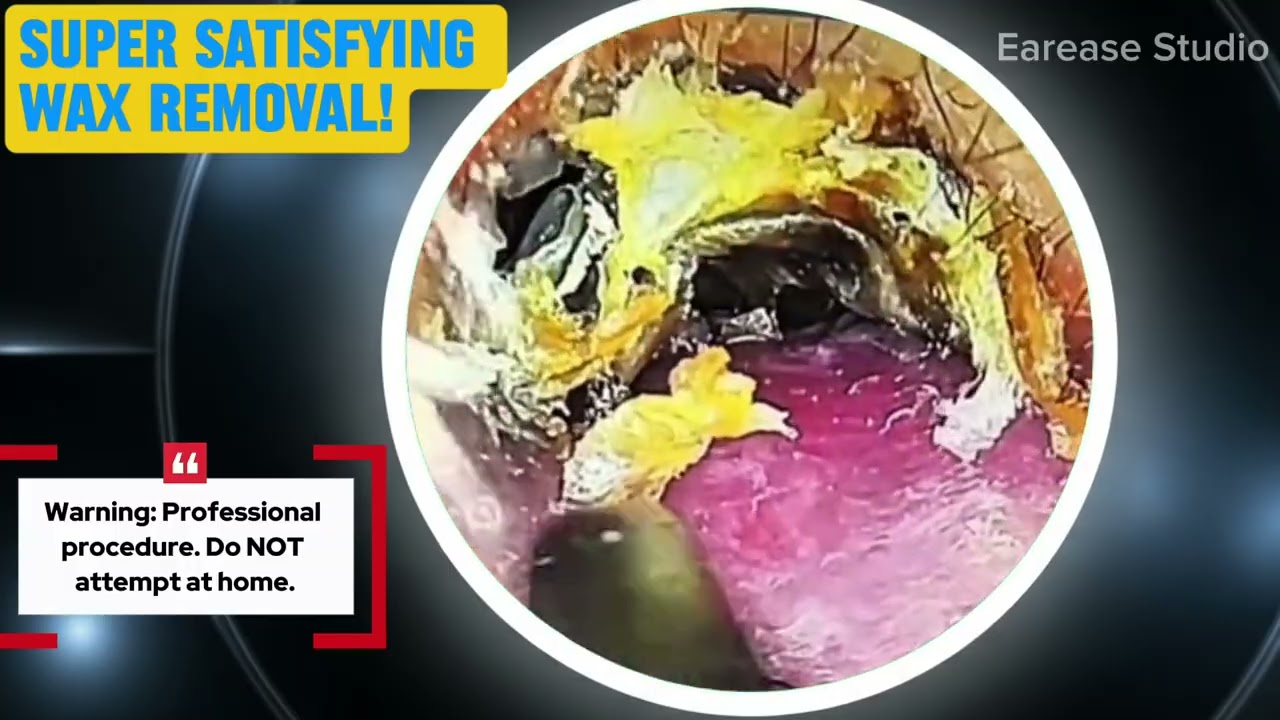 Satisfying Wax Removal – Deep Ear Cleaning ASMR (Super Relaxing!)