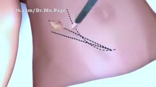 Kidney Transplant animated