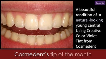 Class IV composite restoration - Enhance Incisal Translucency
