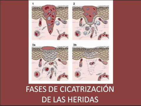 Video: ¿Qué implica la primera fase de cicatrización de heridas?