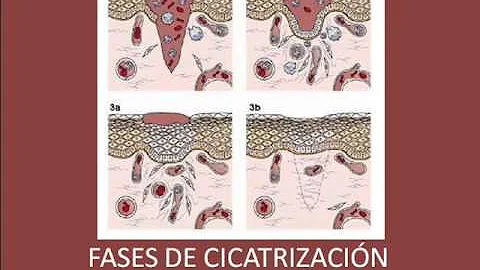 ¿Cuáles son las etapas de la curación?