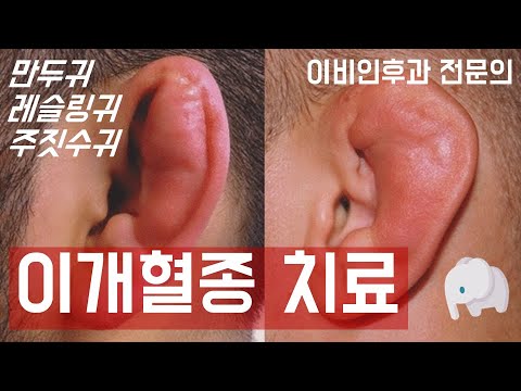 이개혈종(귓바퀴 혈종)의 치료