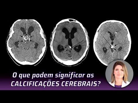 Vídeo: O Mistério De Um Crânio Boscópico Com Um Grande Volume Cerebral - Visão Alternativa