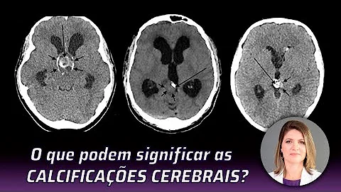 O que é uma calcificação no cérebro?