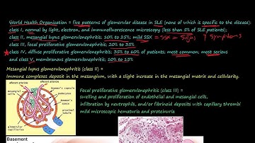 91P  Morphology of Systemic lupus erythematosus, SLE, part 2, glomerular disease in SLE