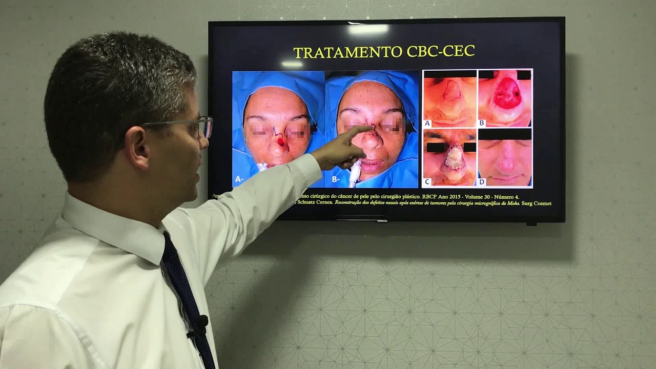 ENTENDA O CÂNCER DE PELE