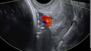 Vasa Praevia Associé À Une Insertion Vélamenteuse Du Cordon Ombilical - Vidéo Et Images Cliniques