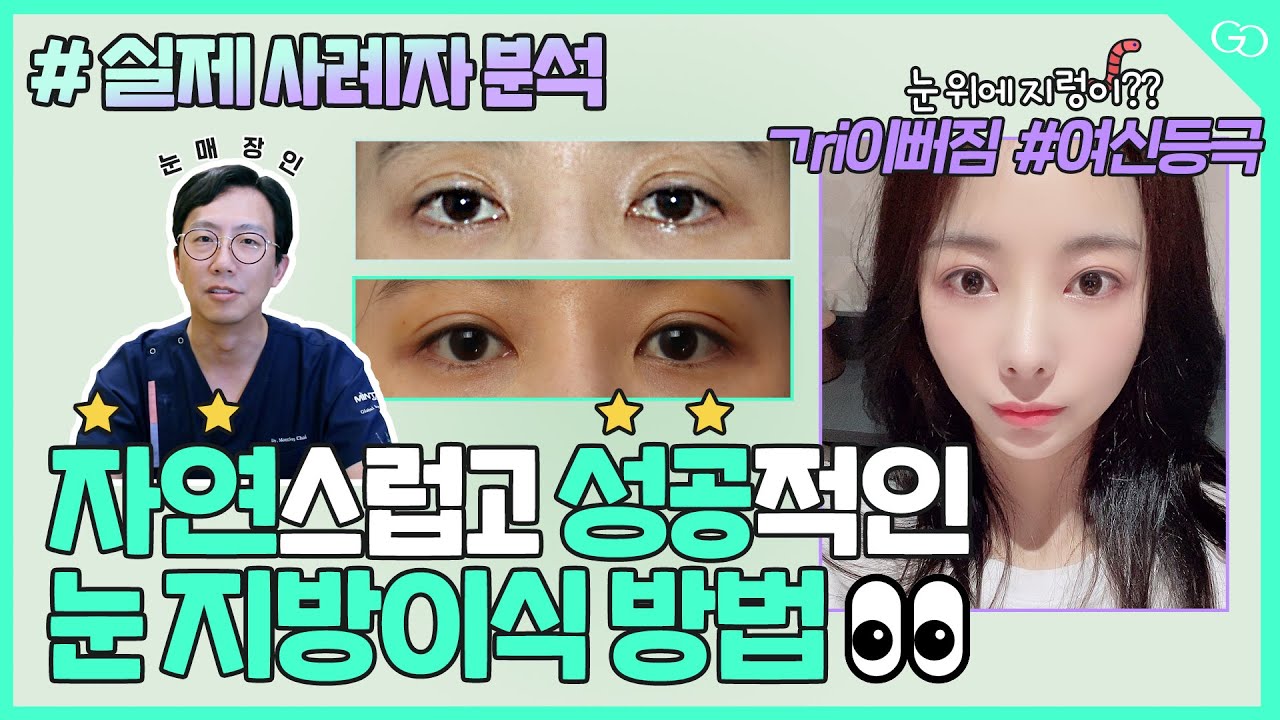 [눈꺼짐 지방이식] 눈 지방이식은 얼굴의 다른 부위와 달라요👀 ｜실제 사례자 분석｜흉터｜지렁이 부작용｜통 vs 나노 지방이식 ｜이식 횟수 💁🏻‍♂️ #그레이스성형외과  (ep.2)
