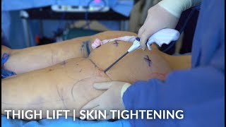 Thigh Lift Surgery | Internal Skin Tightening with Renuvion | Live