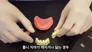 치과 3D프린팅 틀니 제작 과정