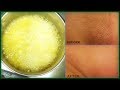 IN JUST  MINUTES REMOVE UNWANTED HAIR, PUBIC ARMPITS UPPER LIPS AND CHIN HAIR |Khichi Beauty