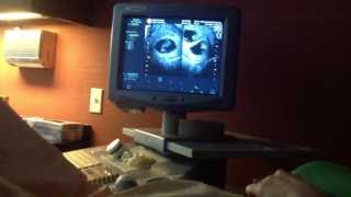 Twin Sonogram - 9w5d