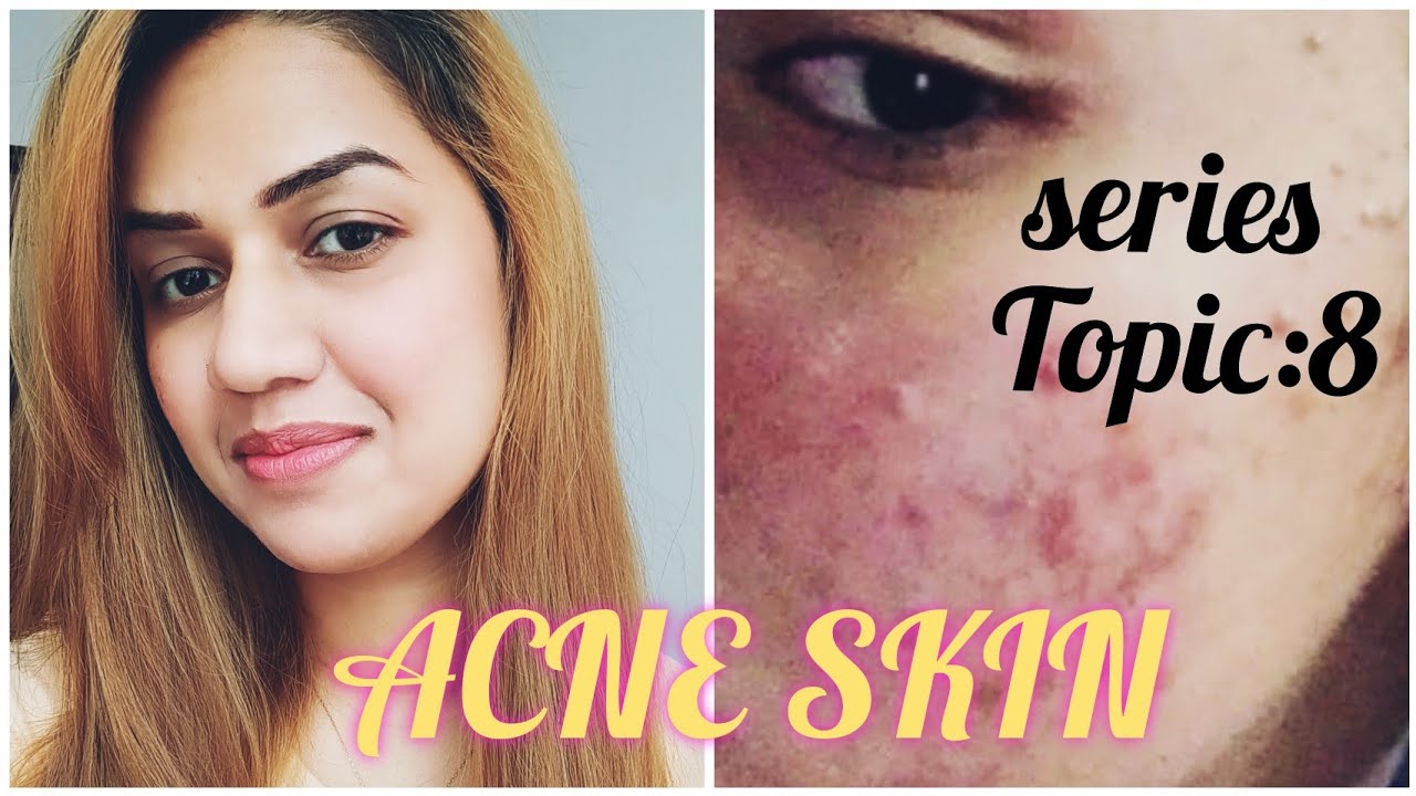 Acne Skin Care Dalacin T Lotion By Sabaparvaiz Youtube