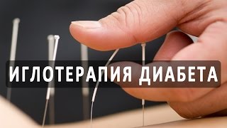 Иглоукалывание (акупунктура) при сахарном диабете Иглоукалывание (акупунктура) при сахарном диабете