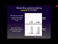 Challenges and Patient Management Strategies Related to Dual Circulations During Veno Arterial ECMO